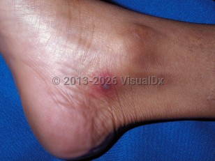 Clinical image of Disseminated gonorrhea - imageId=273456. Click to open in gallery.  caption: 'A grayish cloudy vesicle on a purpuric base near the ankle.'