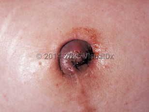 Clinical image of Cutaneous endometriosis - imageId=273500. Click to open in gallery.  caption: 'A pink and grayish nodule in the umbilicus.'