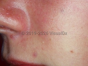 Clinical image of Naso-orbital-ethmoid fracture - imageId=2745955. Click to open in gallery. 