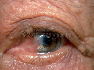Clinical image of Ocular pterygium - imageId=275150. Click to open in gallery.  caption: 'A whitish-gray plaque with overlying telangiectasias extending over the nasal bulbar conjunctiva, iris, and pupil.'
