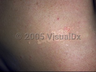 Clinical image of Primary biliary cholangitis - imageId=2755740. Click to open in gallery.  caption: 'A close-up of discrete and confluent yellow papules forming a patterned plaque (plane xanthomas).'