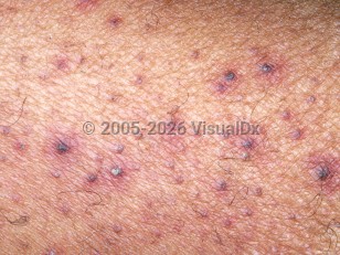 Clinical image of Scurvy - imageId=2760850. Click to open in gallery.  caption: 'A close-up of scattered perifollicular purpura and "corkscrew" hairs.'