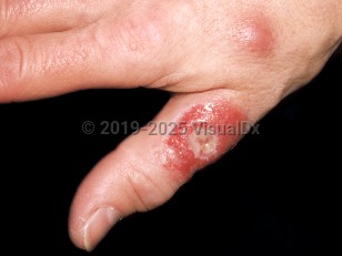 Clinical image of Mycobacterium marinum infection - imageId=276636. Click to open in gallery.  caption: 'An ulcerated, bright red nodule on the thumb and a nearby smooth, pink papule, on the dorsal hand.'