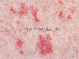 Clinical image of Telangiectasia - imageId=2767459. Click to open in gallery.  caption: 'A close-up of linear and branching red macules (and unrelated pustules).'