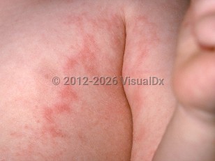 Clinical image of Unilateral laterothoracic exanthem of childhood - imageId=278109. Click to open in gallery.  caption: 'Erythematous papules and plaques, some with a retiform configuration, on the trunk and arm.'