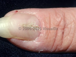 Clinical image of Median nail dystrophy - imageId=2789155. Click to open in gallery.  caption: 'A midline longitudinal split, starting at the cuticle and growing toward the free edge of the nail with a few short, chevron-shaped cracks that extend laterally from the split, giving the appearance of an "inverted fir tree." There is also an enlarged lunula.'