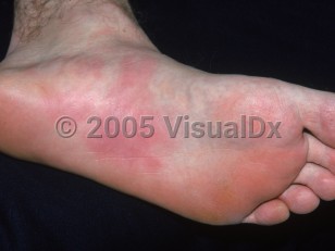 Clinical image of Pressure urticaria - imageId=2790876. Click to open in gallery.  caption: 'Erythematous and edematous plaques on the sole and instep.'