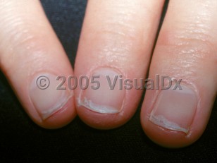 Clinical image of Onychoschizia - imageId=2798515. Click to open in gallery.  caption: 'Transverse splitting of the distal fingernails.'