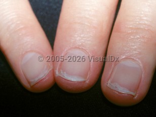 Clinical image of Onychoschizia - imageId=2798515. Click to open in gallery.  caption: 'Transverse splitting of the distal fingernails.'