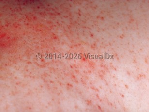 Clinical image of Langerhans cell histiocytosis - imageId=280377. Click to open in gallery.  caption: 'A close-up of showers of erythematous and purpuric macules and papules.'