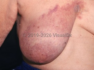 Clinical image of Cutaneous presentations of breast cancer - imageId=2803850. Click to open in gallery.  caption: 'A telangiectatic and purpuric plaque on the breast and medial chest wall.'