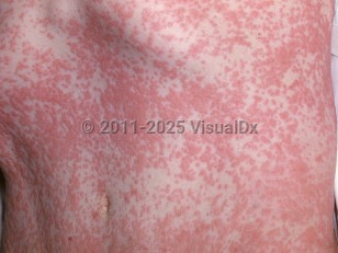Clinical image of Exanthematous drug eruption - imageId=2811647. Click to open in gallery.  caption: 'Widespread erythematous papules and plaques on the abdomen.'