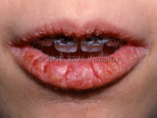 Clinical image of Cheilitis - imageId=2817180. Click to open in gallery.  caption: 'Cracked, eroded, and crusted plaques on the lips.'
