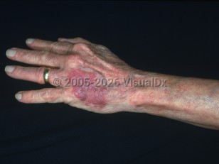 Clinical image of Solar purpura - imageId=2834784. Click to open in gallery.  caption: 'A purpuric patch on the dorsal hand.&nbsp;'