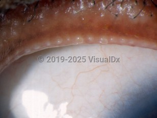 Ophthalmic Imaging image of Meibomitis - imageId=2840028. Click to open in gallery.  caption: 'Prominent tiny papules at the eyelid margin.'