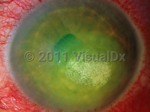 Ophthalmic Imaging image of Drug-induced corneal deposits - imageId=2841676. Click to open in gallery.  caption: 'A green-white corneal deposit secondary to ciprofloxacin drops.'