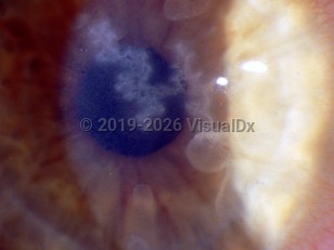 Ophthalmic Imaging image of Herpes simplex virus keratitis - imageId=2842477. Click to open in gallery.  caption: 'A dendritic corneal ulcer.'