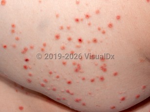 Clinical image of Pityriasis lichenoides et varioliformis acuta - imageId=2861923. Click to open in gallery.  caption: 'Many erythematous papules, some with overlying hemorrhagic crusting, on the buttocks.'