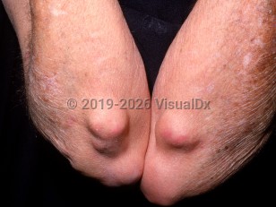 Clinical image of Rheumatoid nodule - imageId=2870478. Click to open in gallery.  caption: 'Numerous pink and skin-colored nodules, of varying sizes, over the elbows.'