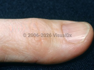 Clinical image of Longitudinal nail ridging - imageId=2882816. Click to open in gallery.  caption: 'Pronounced longitudinal ridges in the thumbnail.'