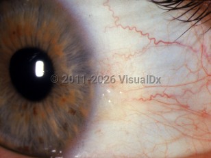 Ophthalmic Imaging image of Pinguecula - imageId=2892787. Click to open in gallery. 