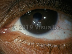 Ophthalmic Imaging image of Distichiasis - imageId=2903865. Click to open in gallery.  caption: 'Tiny hairs arising from meibomian gland openings on the eyelid margin.'