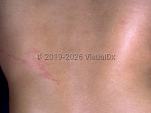 Gnathostomiasis