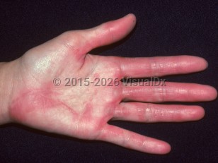 Toxic shock syndrome