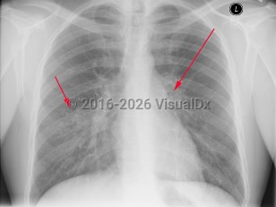 Imaging Studies image of Tuberculosis - imageId=2958883. Click to open in gallery.  caption: 'Frontal chest x-ray with patchy consolidation in the lower lobes bilaterally, right greater than left, (short arrow).&nbsp; There is also mediastinal adenopathy, (long arrow).'