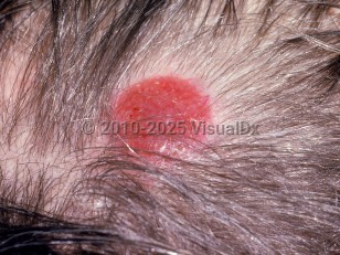 Clinical image of Alopecia neoplastica - imageId=2962452. Click to open in gallery.  caption: 'A bright red nodule with associated alopecia on the scalp.'
