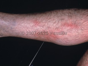 Clinical image of Superficial thrombophlebitis - imageId=2974016. Click to open in gallery.  caption: 'Linear erythematous patches on the leg.'