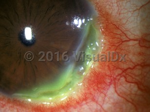 Ophthalmic Imaging image of Marginal keratitis - imageId=2977593. Click to open in gallery. 