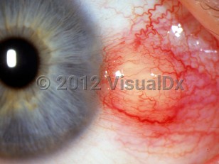 Ophthalmic Imaging image of Sebaceous carcinoma - imageId=2993598. Click to open in gallery. 