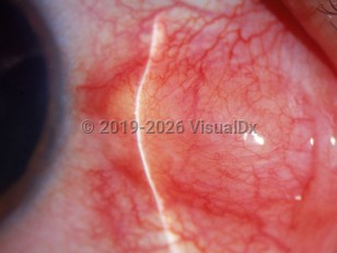 Ophthalmic Imaging image of Nodular episcleritis - imageId=2994396. Click to open in gallery. 