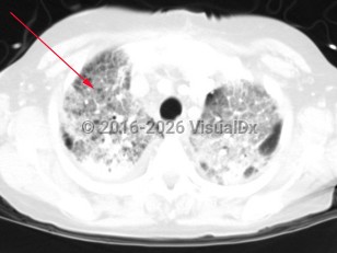 Imaging Studies image of Haemophilus influenzae pneumonia - imageId=2997660. Click to open in gallery.  caption: 'Image from CT scan of the chest in lung windows demonstrating bilateral, diffuse ground glass opacities in the setting of chronic lung disease.&nbsp;'