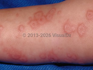 Erythema multiforme