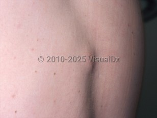 Clinical image of Lipoma - imageId=301128. Click to open in gallery.  caption: 'Skin-colored and slightly pink nodule on the back.'