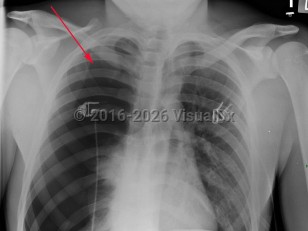 Imaging Studies image of Spontaneous pneumothorax - imageId=3028277. Click to open in gallery.  caption: 'Frontal chest x-ray with a large right pneumothorax with complete collapse of the right lung.'
