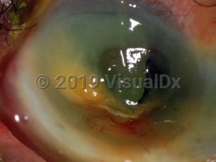 Ophthalmic Imaging image of Corneal chemical burn - imageId=3098984. Click to open in gallery. 