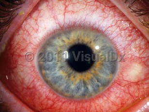 Ophthalmic Imaging image of Toxic conjunctivitis - imageId=3140555. Click to open in gallery. 