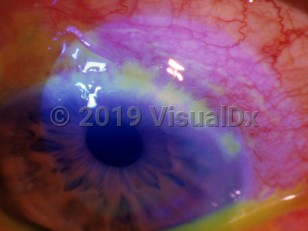 Ophthalmic Imaging image of Herpes simplex virus conjunctivitis - imageId=3175118. Click to open in gallery. 