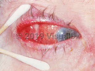 Clinical image of Lacrimal gland tumor - imageId=3180152. Click to open in gallery.  caption: 'A glistening mass at the lateral eye with marked conjunctival injection.'