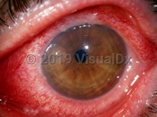 Ophthalmic Imaging image of Bacterial conjunctivitis - imageId=3193157. Click to open in gallery. 