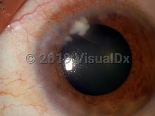 Ophthalmic Imaging image of Ocular staphylococcal hypersensitivity - imageId=3242048. Click to open in gallery. 