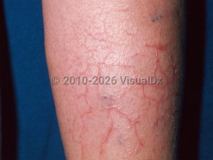 Clinical image of Eczema craquelé - imageId=328387. Click to open in gallery.  caption: 'Polygonal and angulated cracks, each flanked by fine white scales, on the shin.'