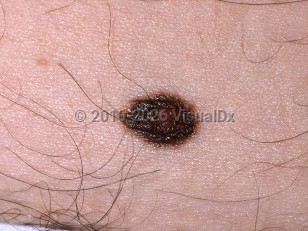 Clinical image of Atypical nevus - imageId=329573. Click to open in gallery.  caption: 'A close-up of a dark brown plaque with a central pinkish papule and a lighter brown rim.'