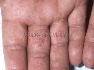Dyshidrotic dermatitis