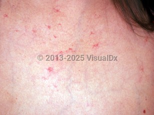 Clinical image of Alcohol use disorder - imageId=3314467. Click to open in gallery.  caption: '<span>Secondary telangiectasia to alcoholism</span>.'