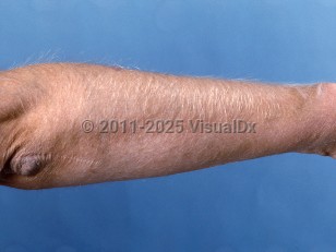 Clinical image of Acquired hypertrichosis lanuginosa - imageId=336883. Click to open in gallery.  caption: 'Marked hypertrichosis lanuginosa on the arm, secondary to a medication.'
