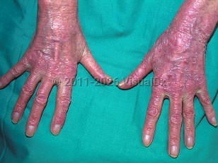 Clinical image of Drug-induced photoallergic reaction - imageId=341044. Click to open in gallery.  caption: 'Widespread scaly and crusted pink plaques on dorsal hands and fingers, secondary to a medication.'